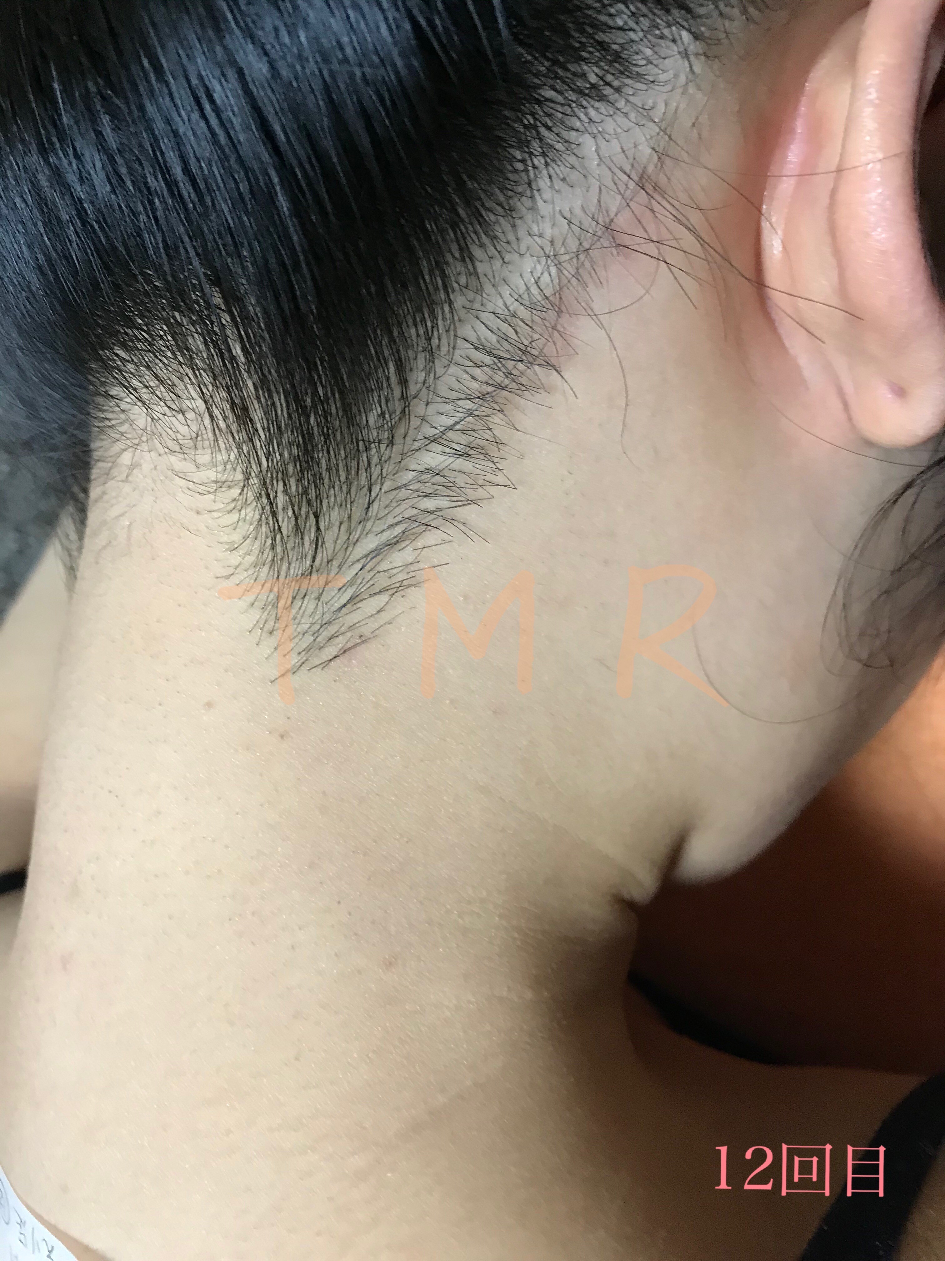 うなじ髪の毛 えりあし脱毛 背毛 牛久脱毛 取手脱毛