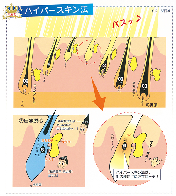 現在の脱毛は進化しました！！