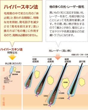 ハイパースキン脱毛法は低温処理の脱毛